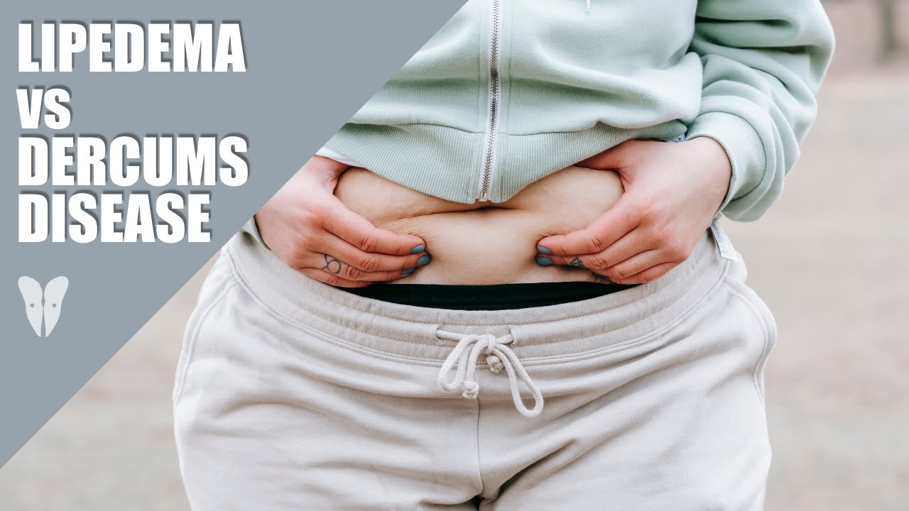 Lipedema vs Dercum's Disease | Dr. Karen Herbst | Total Lipedema Care