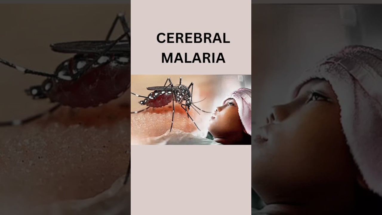 Cerebral Malaria #medicine #malariatreatment #falciparum