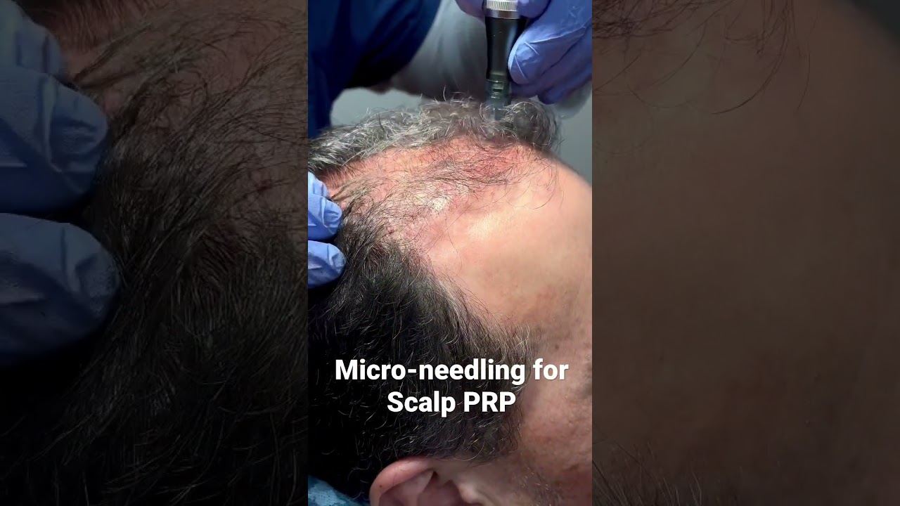 Micro-needling for Scalp PRP for Hair Loss