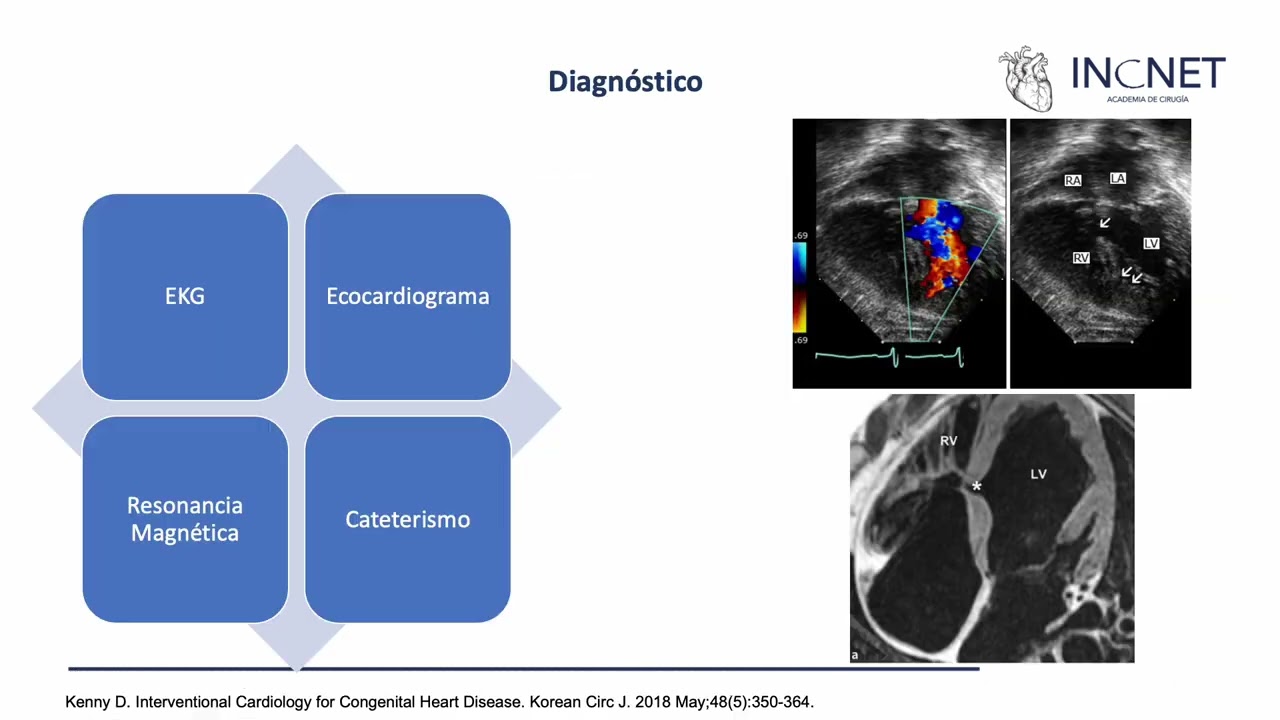 Comunicación interventricular