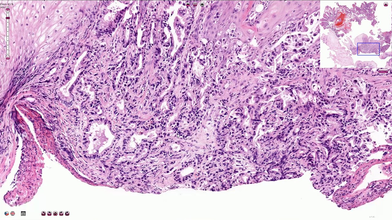 Adenocarcinoma of the Esophagus - Histopathology