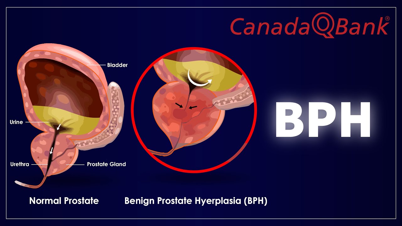 Benign Prostatic Hyperplasia (BPH): Symptoms, Diagnosis & Treatment | Urology Explained