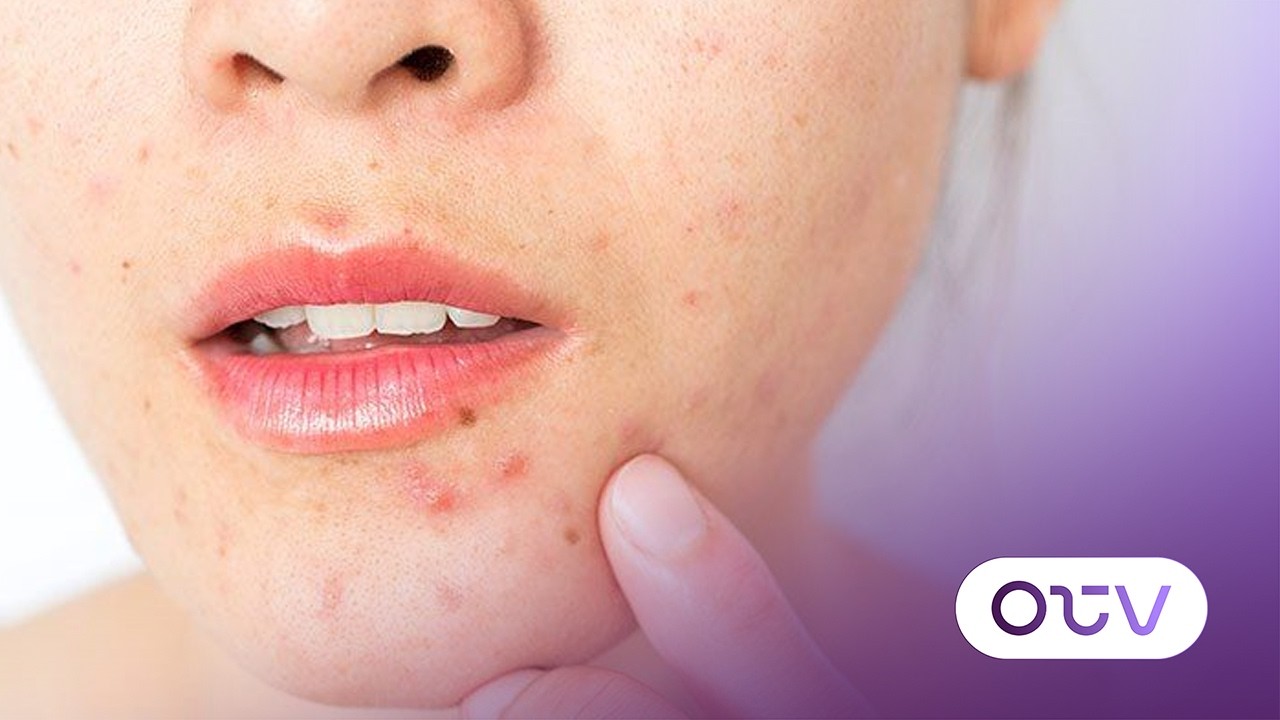 لماذا تظهر الحبوب الملتهبة مع نموّ الوبر في الوجه في الوقت نفسه؟