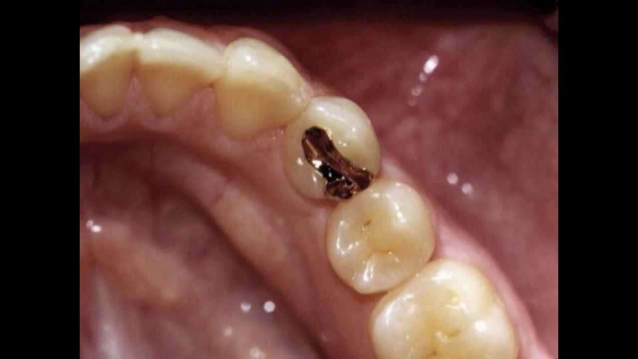 Gold Indirect Inlay or Onlay Restorations | Lake Merritt Dental, Oakland, CA