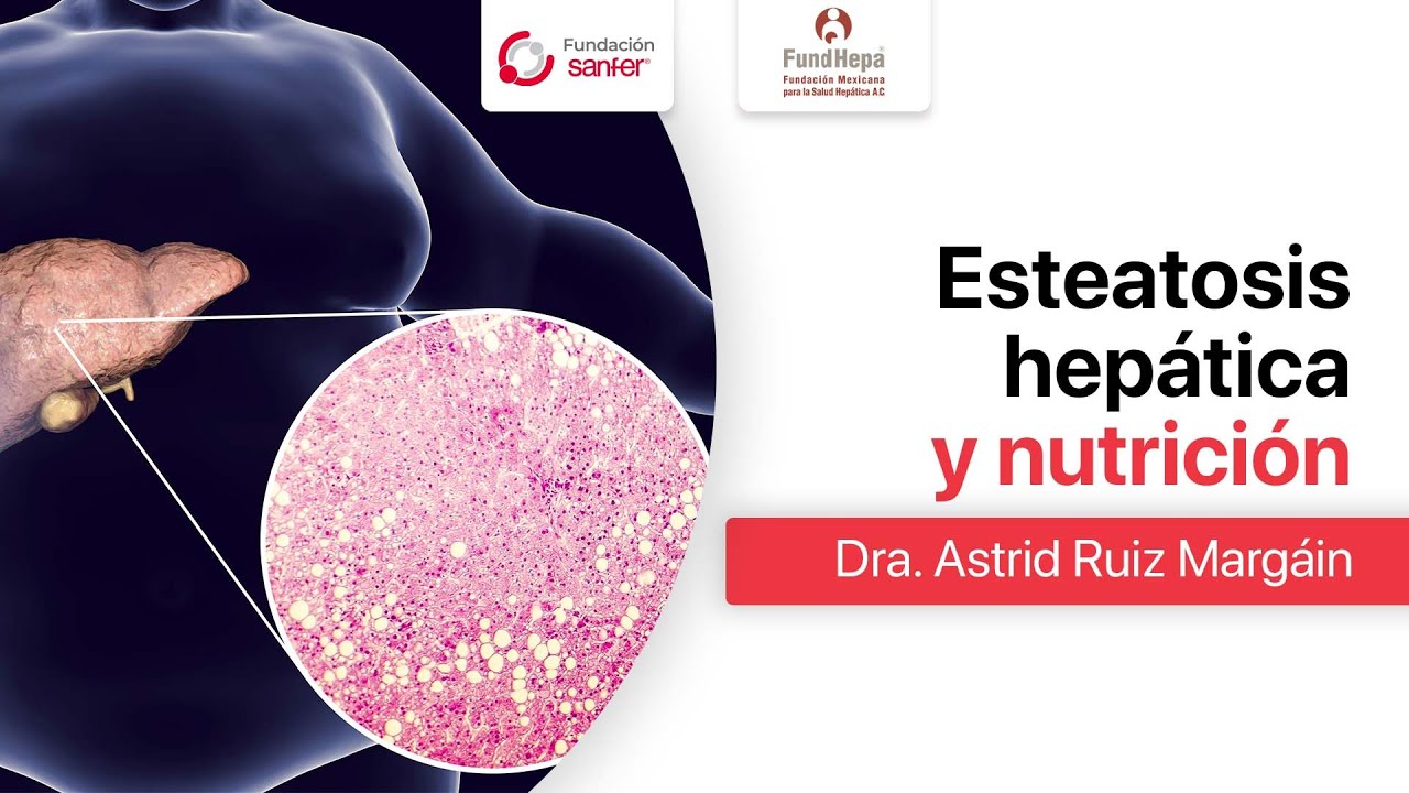 Esteatosis hep&aacute;tica y #nutrici&oacute;n | #FundHepa