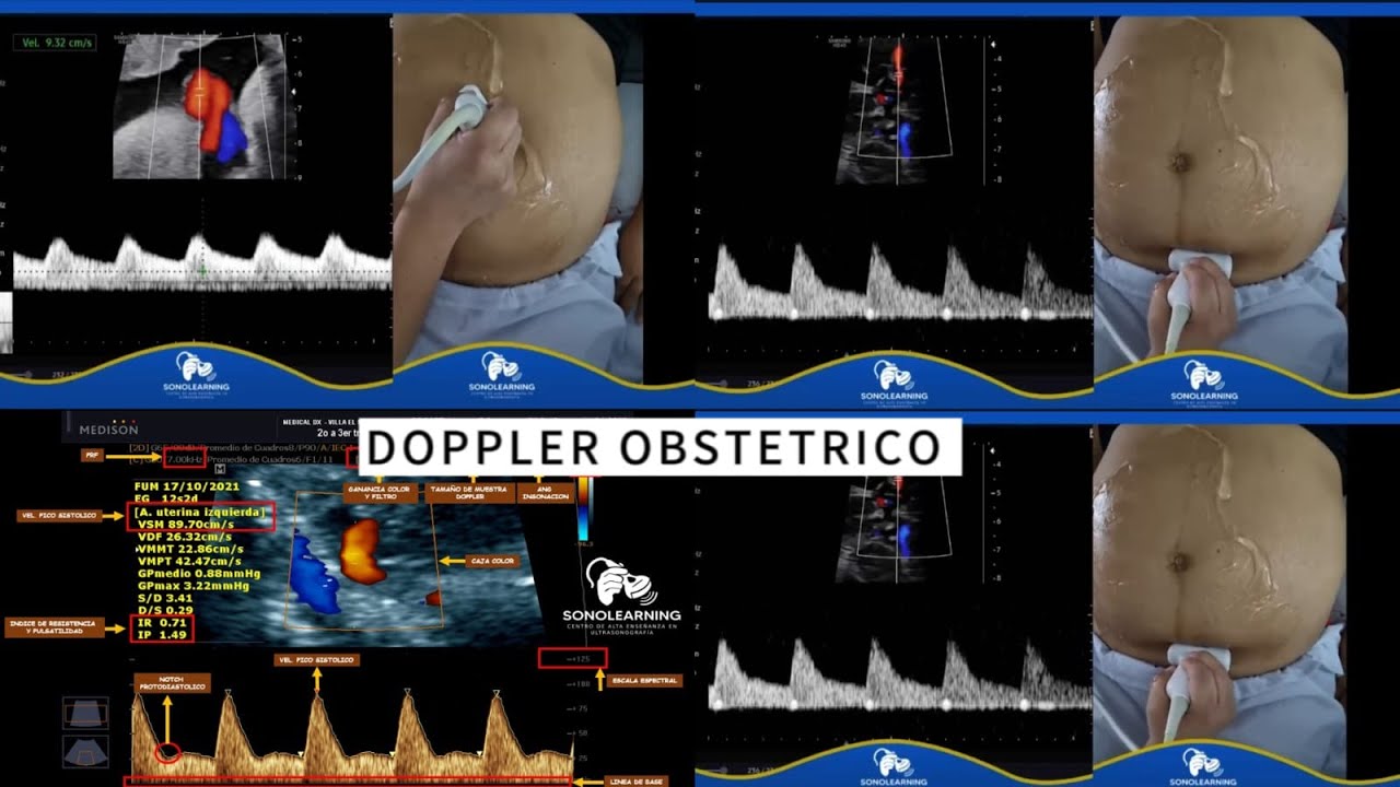 TECNICA DOPPLER OBSTETRICO BASICO
