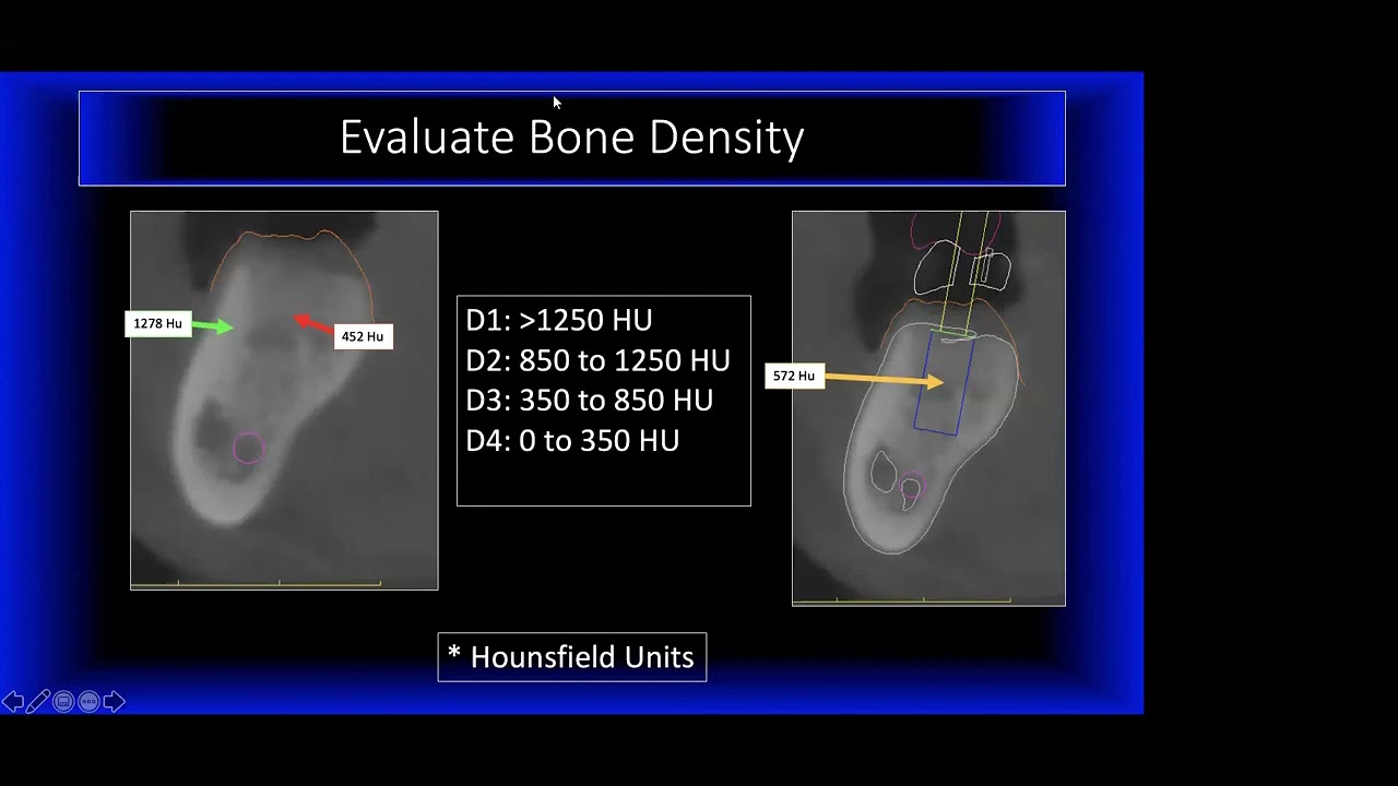 Видео-кейс 1 - Планирование КТ с конусным лучом (CBCT) от доктора Резника