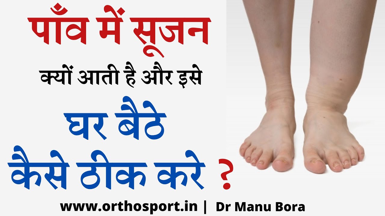 Ankle and Leg Swelling | घर बैठे पाइए एडी में सूजन, पाँव में सूजन का सटीक इलाज Complete Info Hindi