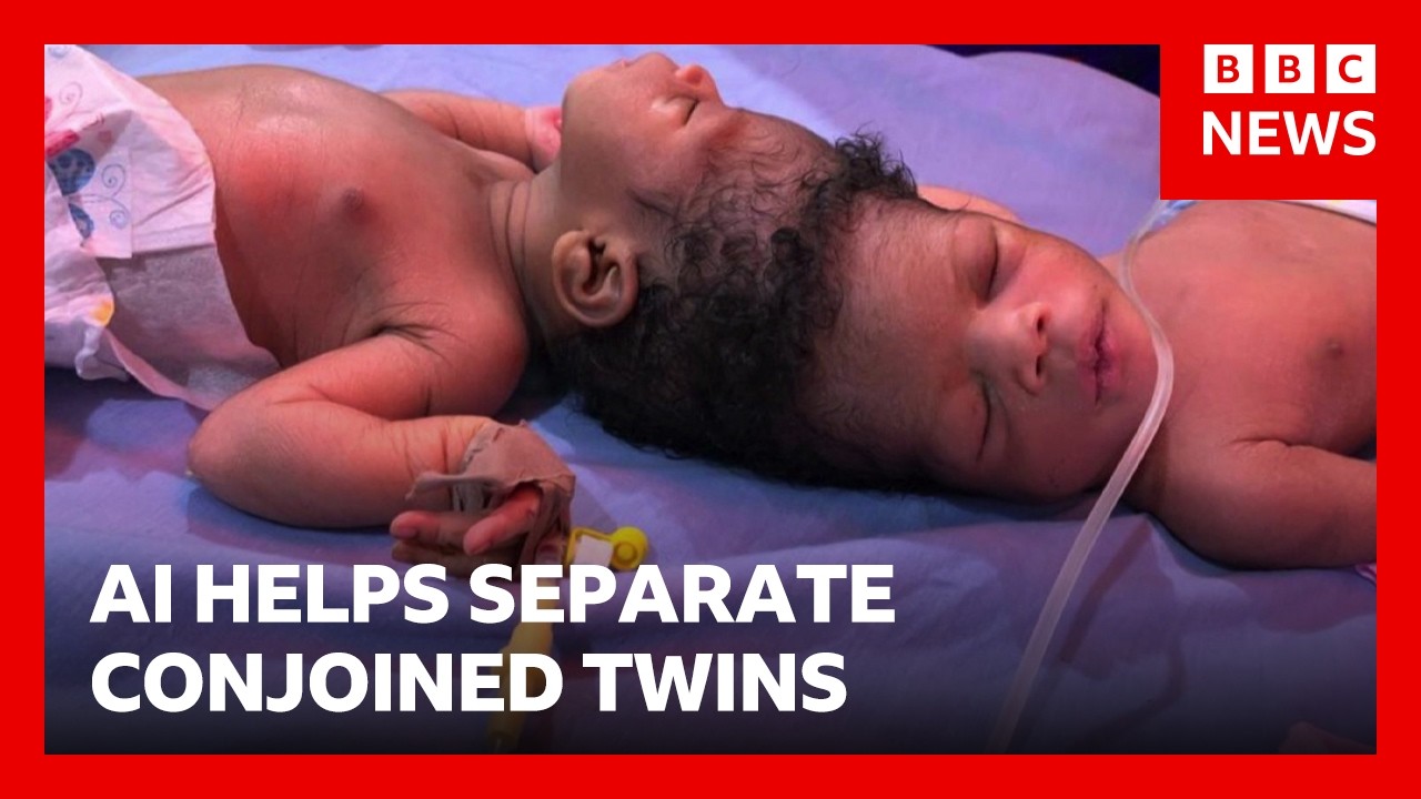 Conjoined twins separated with the help of AI | BBC News