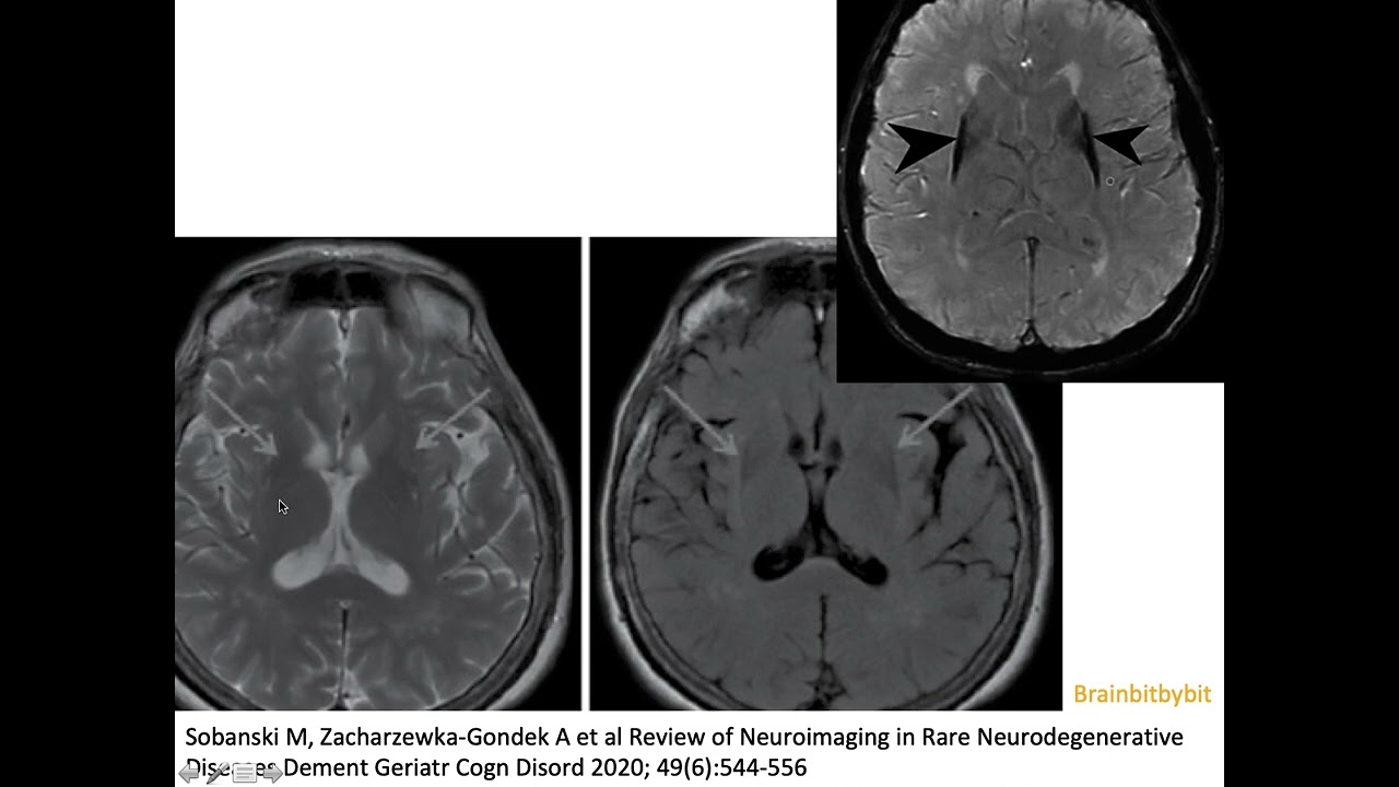 22. Multi System Atrophy; MSA, parkinsonism, putaminal rim, hot cross bun, Papp Lantos, neuroimaging
