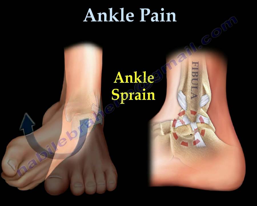 Ankle Pain, ankle ligaments sprain - Everything You Need To Know - Dr. Nabil Ebraheim