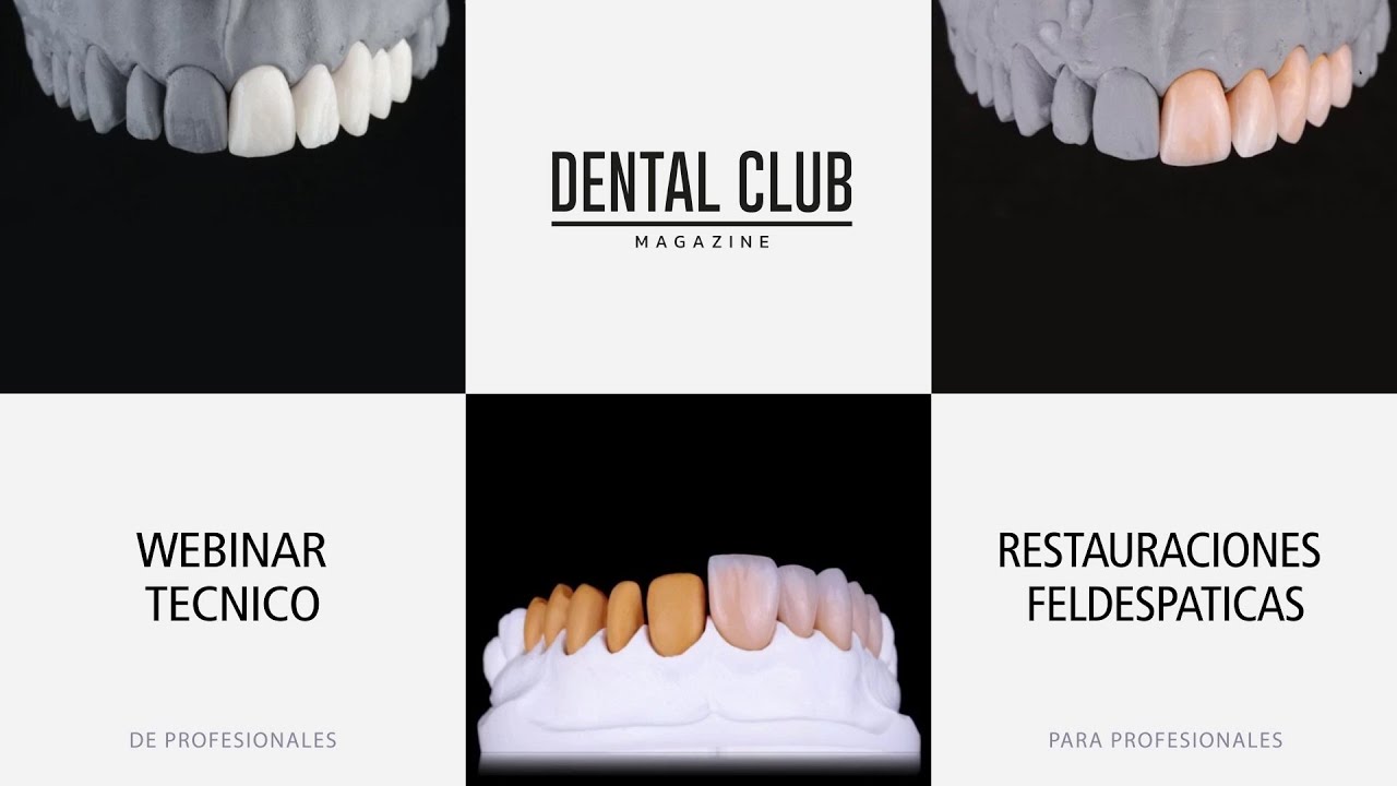 Porque no se ha quedado atras el uso de restauraciones feldespáticas - Webinar Online