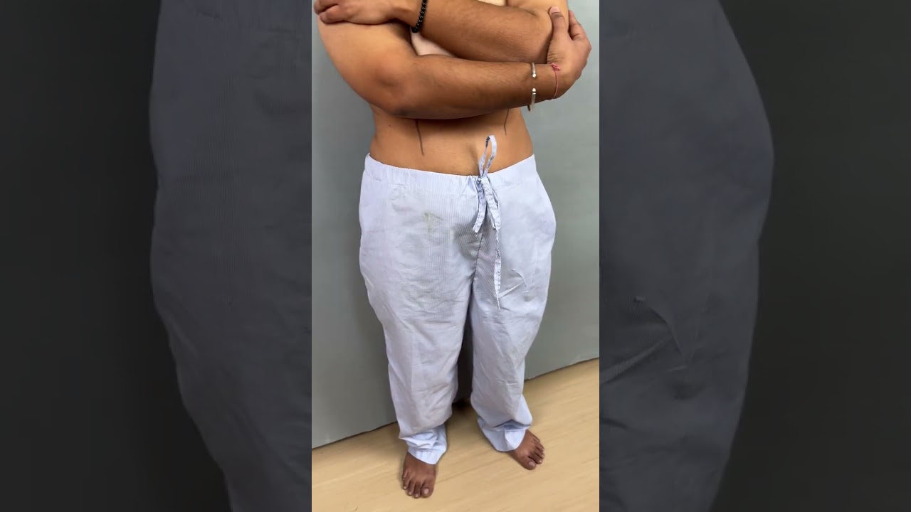 Ftm double incision surgery