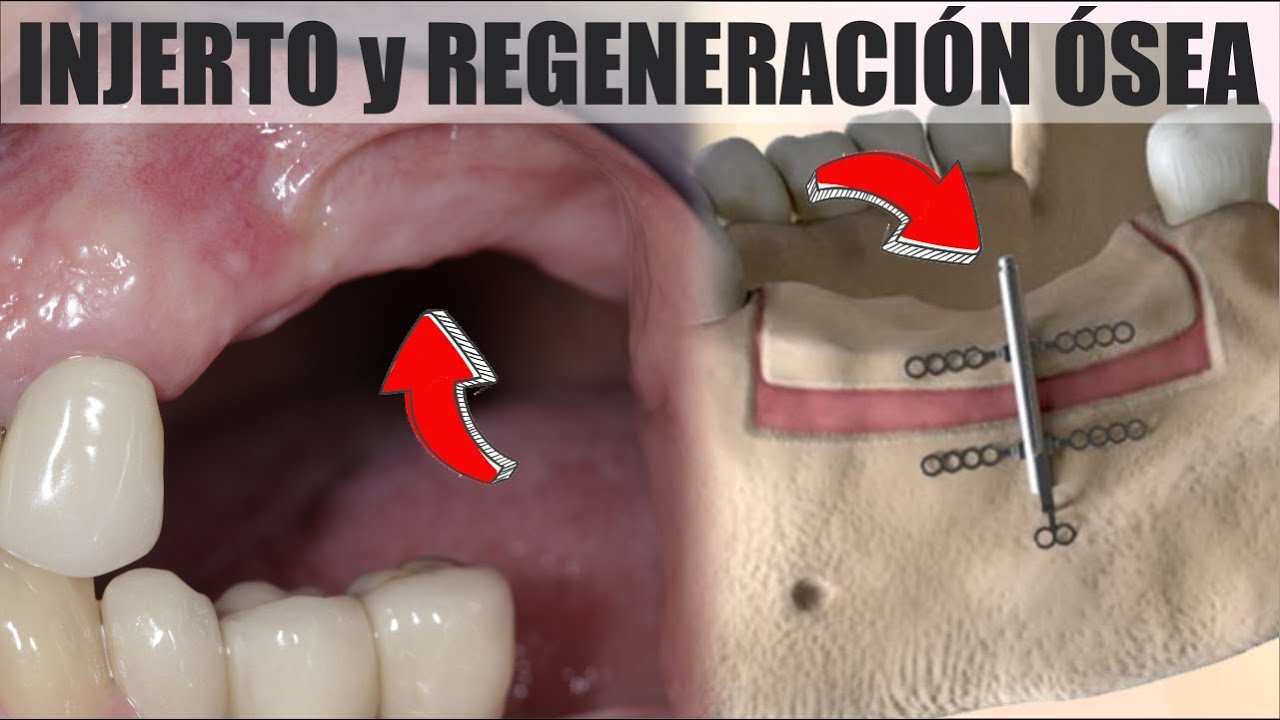 REGENERACIÓN  ÓSEA E INJERTO 💀 IMPLANTE DENTAL en poco HUESO MAXILAR 🦷 Dr YURI MARTINEZ 💋 Prodent