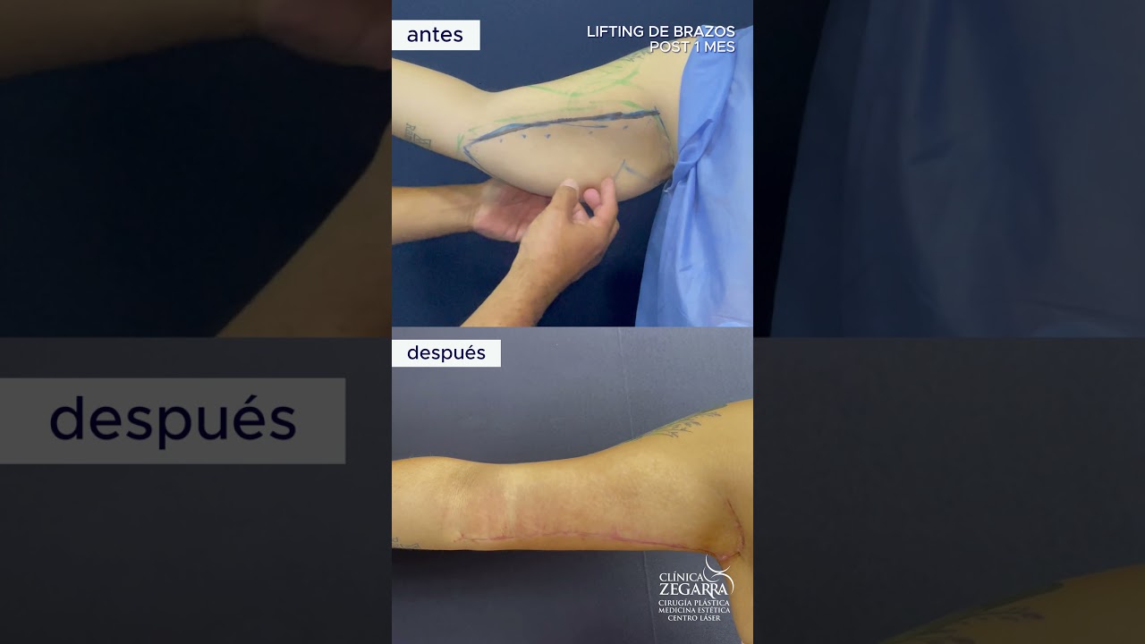 LIFTING DE BRAZOS - POST 1 MES + TRATAMIENTO INDIBA   #clinicazegarra #cirug&iacute;aest&eacute;tica