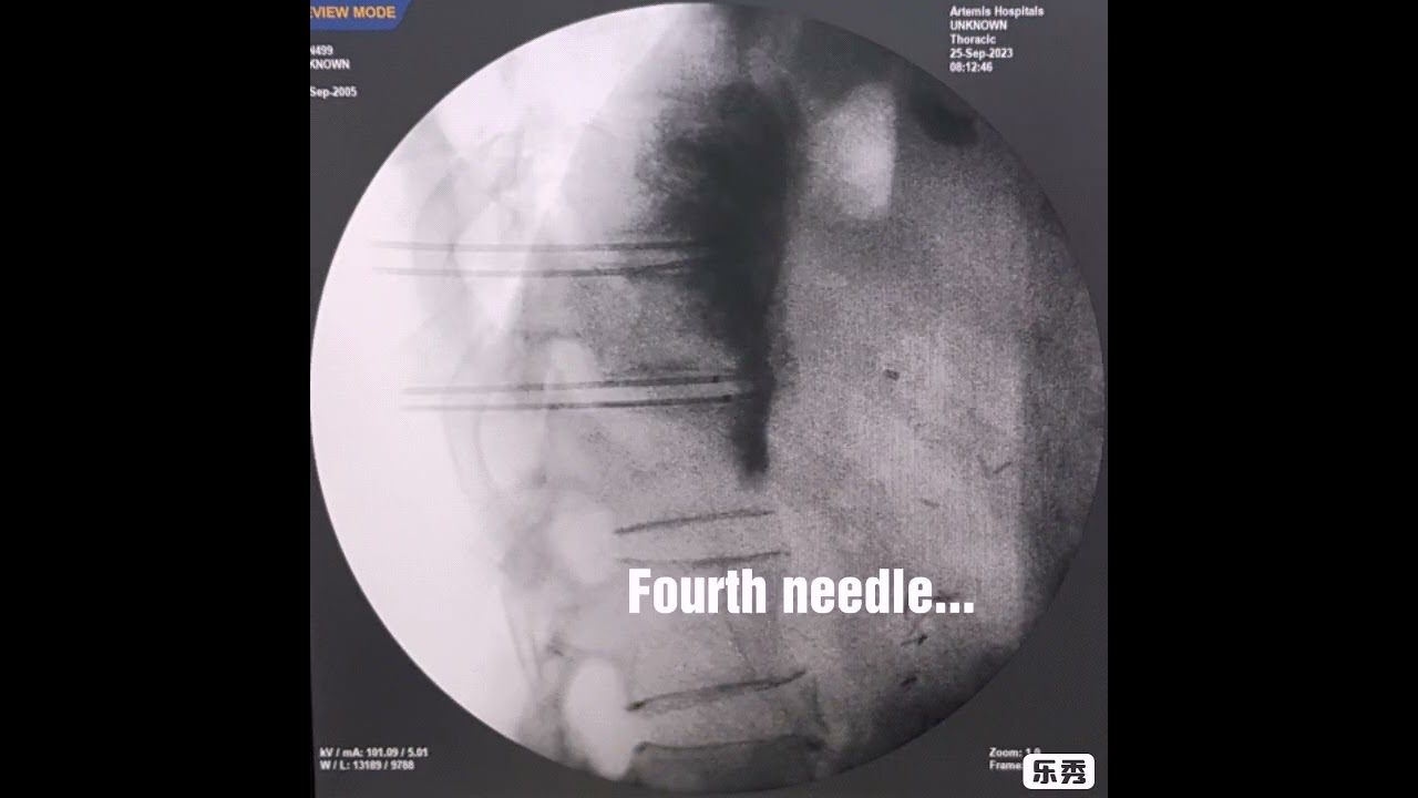 Splanchnic Neurolysis