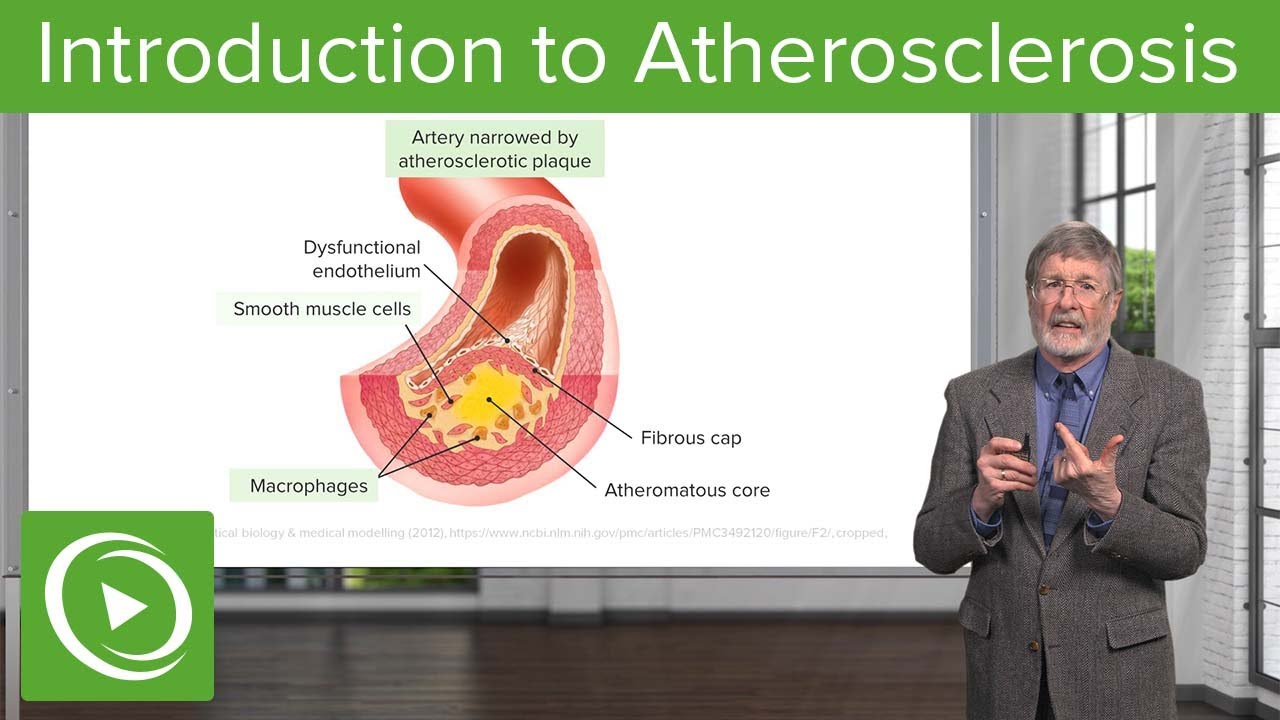 Introduction to Atherosclerosis | Cellular Pathology