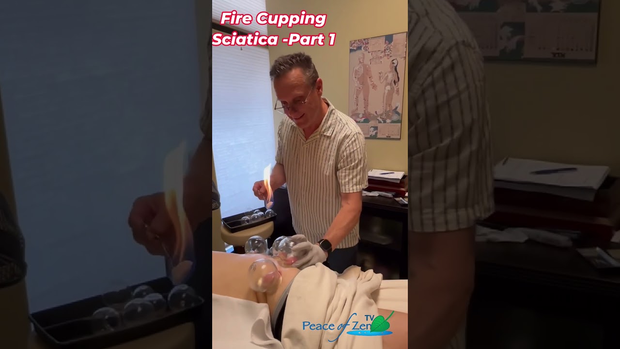 Fire Cupping for Sciatica & Low Back Pain Relief | Deep Circulation Therapy 🌿 #firecupping #cupping