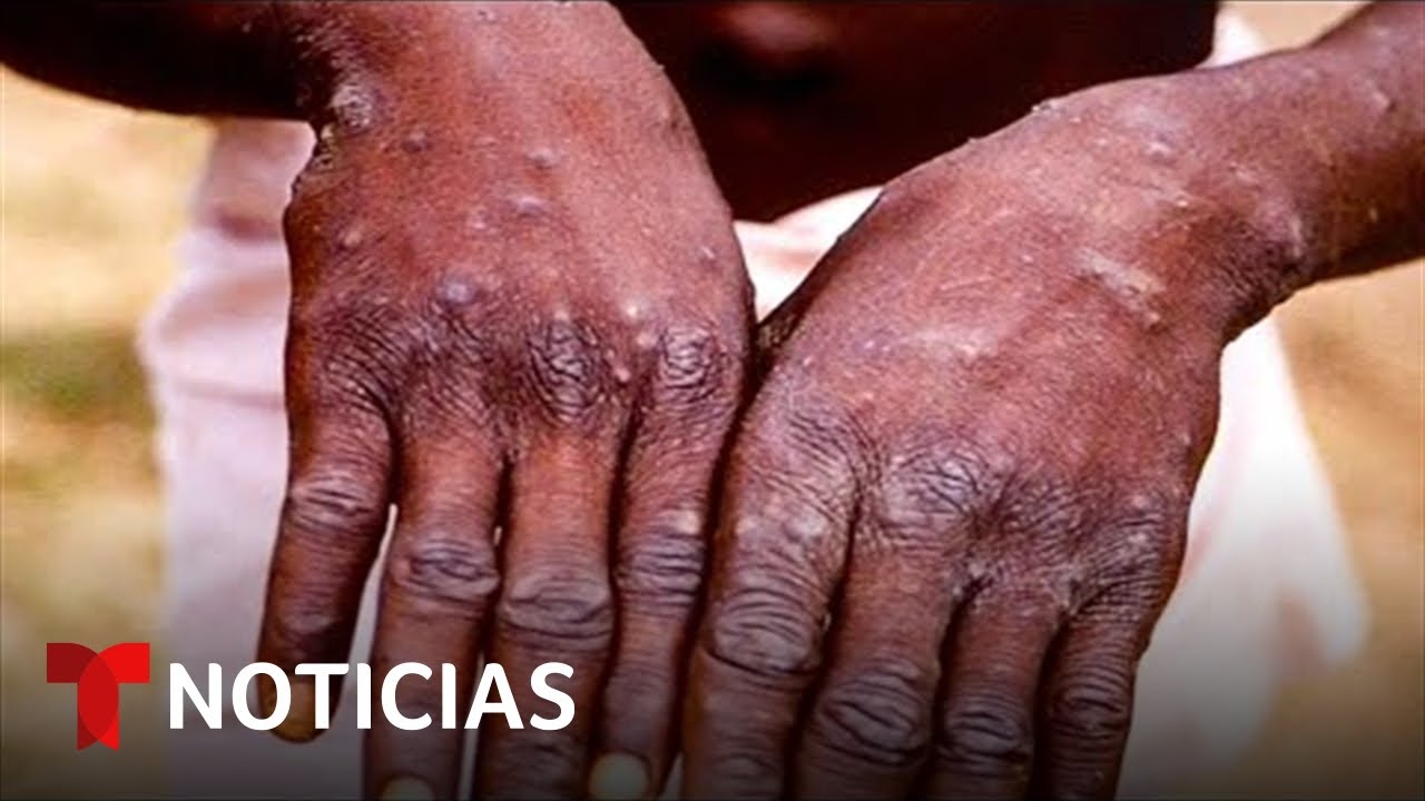 ¿Cómo se contagia la viruela del mono? Una experta lo aclara | Noticias Telemundo
