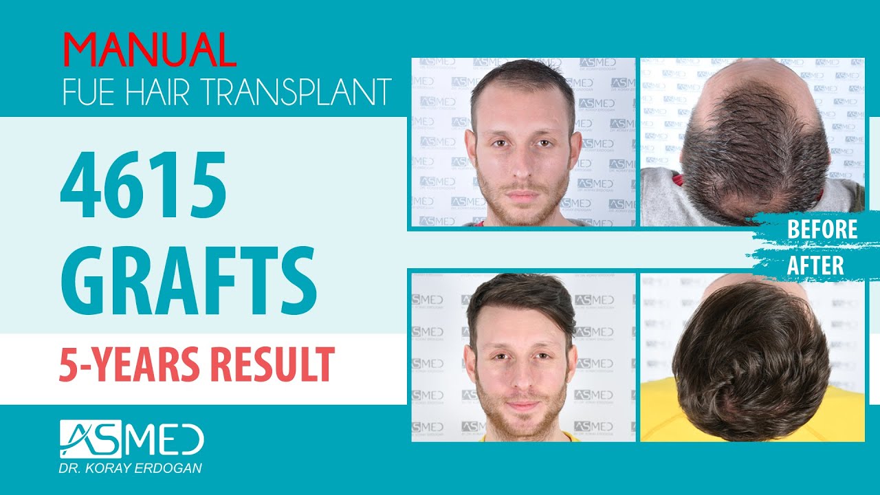 Why are Temporal Peaks Important? Manual FUE Hair Transplant 4615 Grafts 5 Years Result. ​