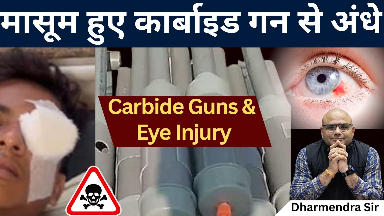 Carbide Gun & Eye Injury #dharmendrasir #chemistry #upsc #civilservices #eyeinjury #carbide #diwali
