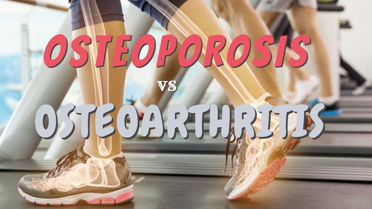 OSTEOPOROSIS vs OSTEOARTHRITIS