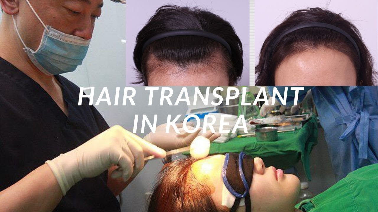 Пересадка волос в Корее | Seoul Guide Medical