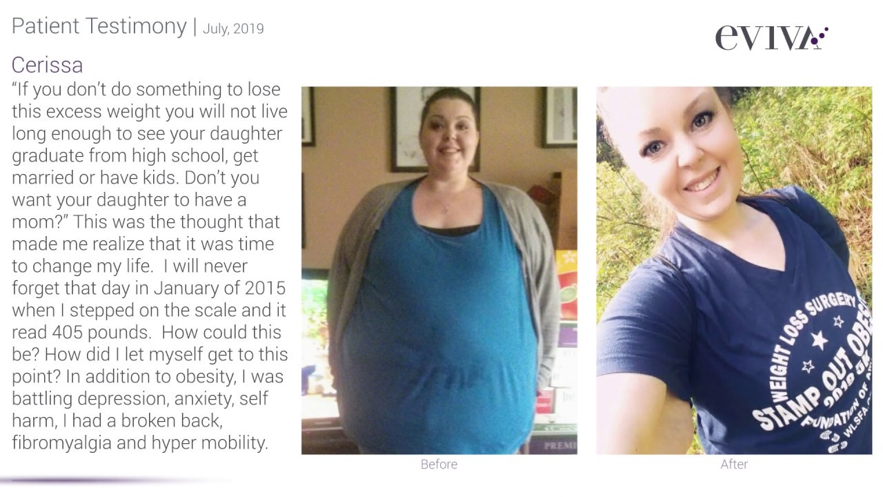 Vertical Sleeve Gastrectomy Before and After | Eviva