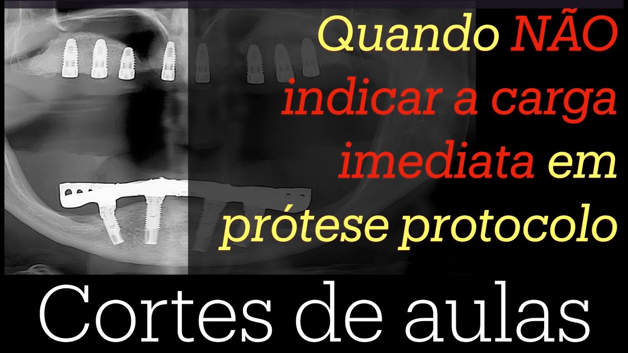 Quando NÃO indicar a carga imediata em prótese protocolo.