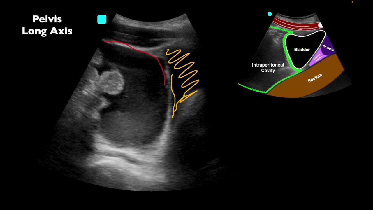 POCUS: Положительный E-FAST после MVC — можете ли вы выделить все результаты?