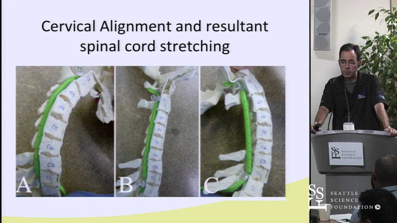Management of Cervical Stenosis: Anterior vs Posterior Approaches by Charles Sansur, M.D.