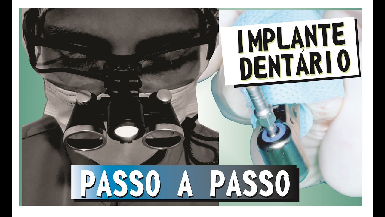 Ep. 14 - Como se faz um implante dentário? passo-a-passo!