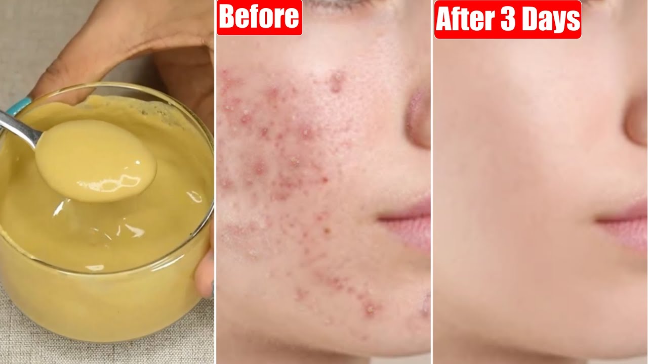 I applied👆🏼this-for just 3 Days-Got Clear Smooth Skin-Cleared all Acne, Whiteheads, Pimples & Bumps