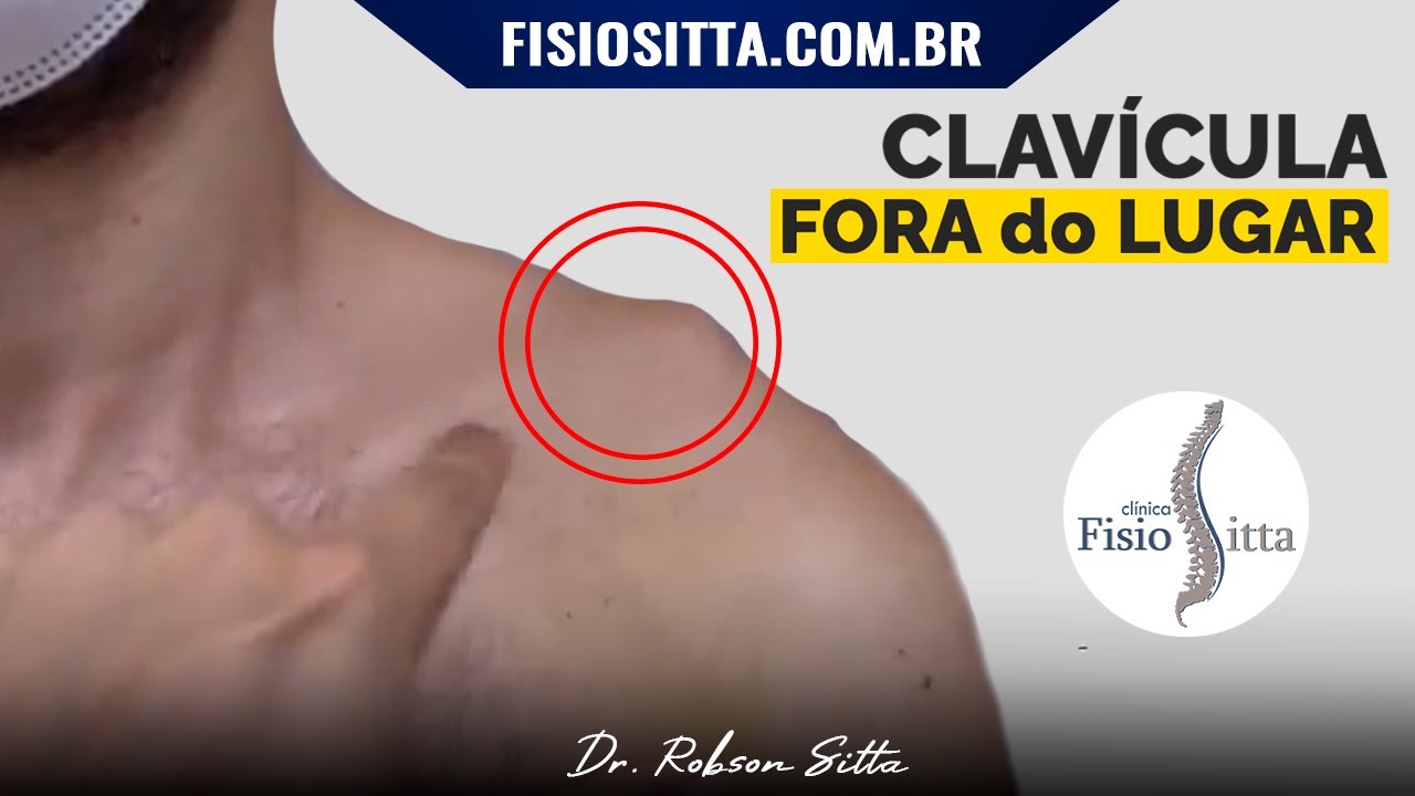 OMBRO LUXAÇÃO ACROMIOCLAVICULAR TRATAMENTO SEM CIRURGIA Clínica de Fisioterapia Dr. Robson Sitta