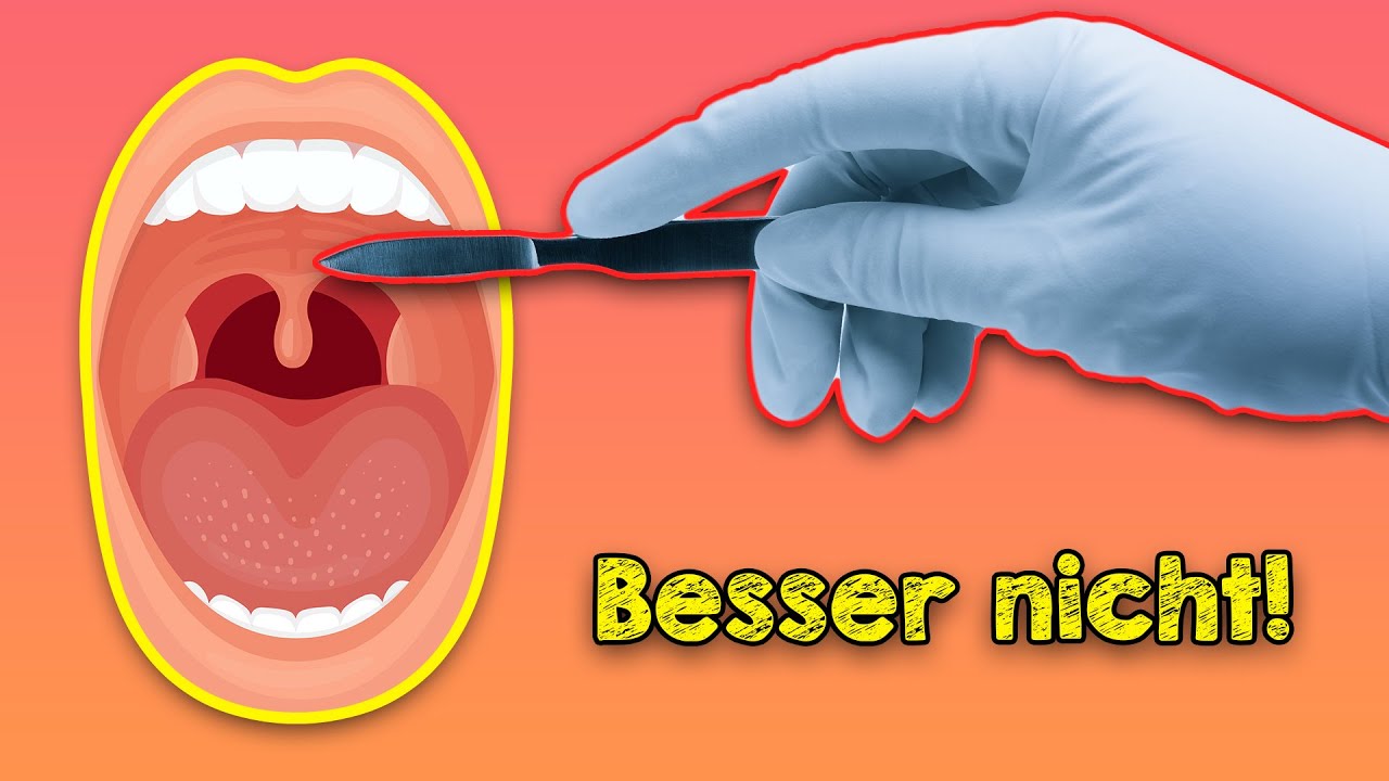 Die Wahrheit über Gaumensegel OPs: Besser trainieren als operieren