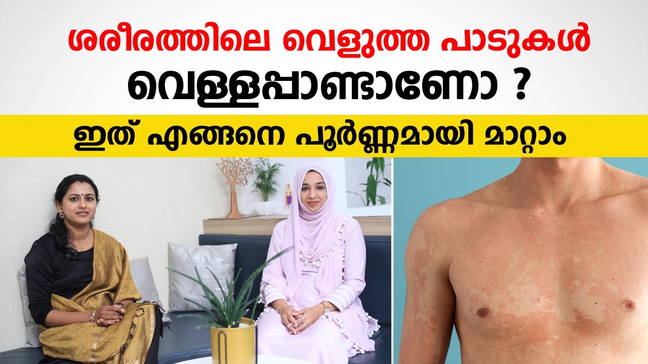 ശരീരത്തിലെ വെളുത്ത പാടുകൾ പൂർണ്ണമായി മാറ്റാം | Vitiligo treatment | Dr Lasida Ali