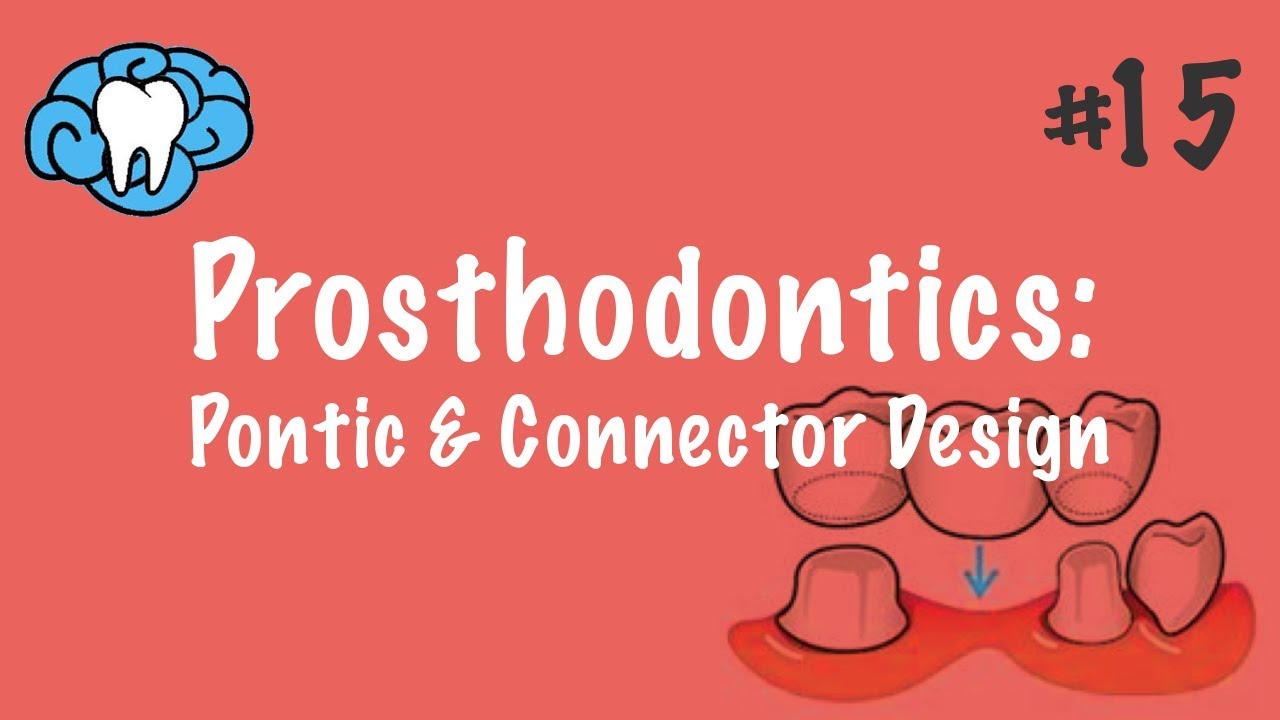 Prosthodontics | Pontic & Connector Design | INBDE, ADAT