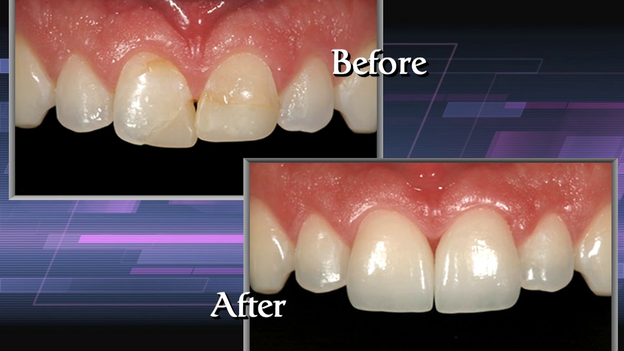 Considering Lumineers, Veneers, or Crowns in Los Angeles? Dr. Anthony Mobasser - Celebrity Dentist