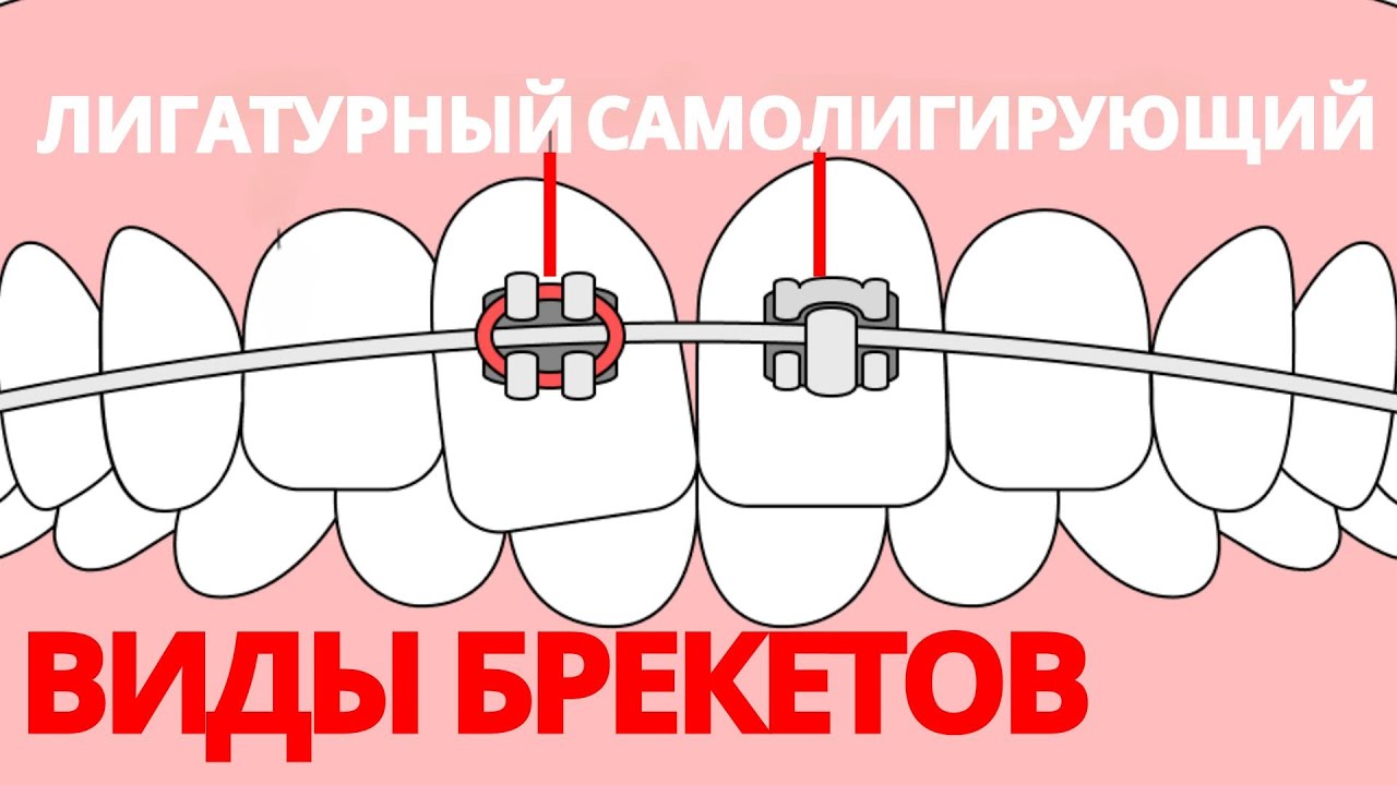 Какие ВЫБРАТЬ БРЕКЕТЫ? Лигатурные vs самолигирующиеся