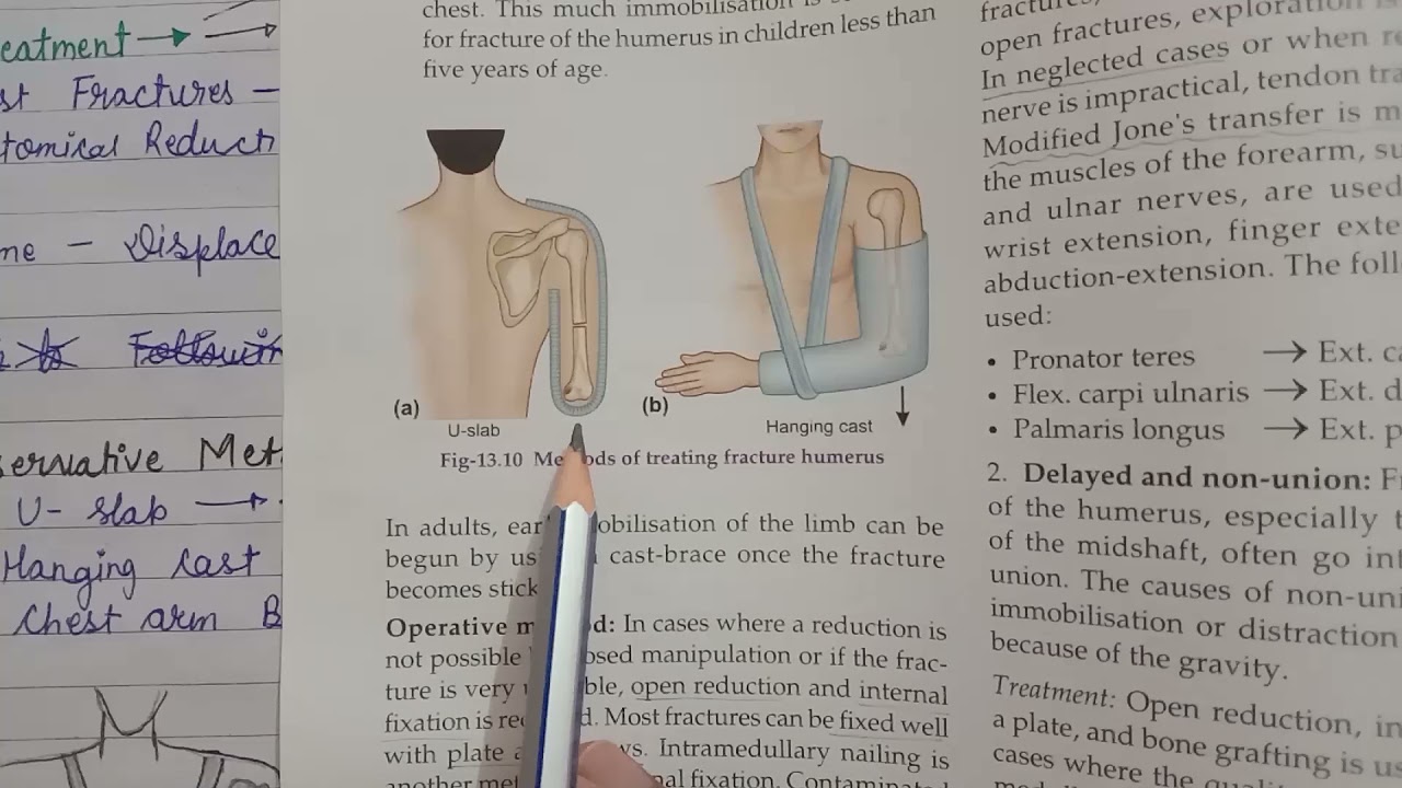 Fracture of the Shaft of the Humerus