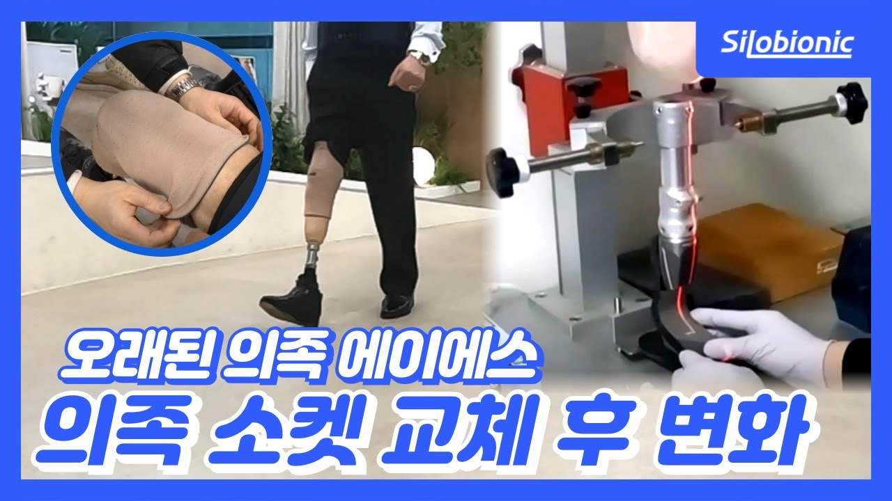 🦶에이에스 의족 소켓 교체 후 변화✨