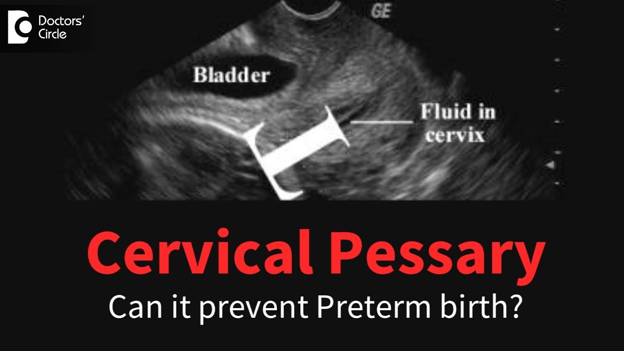 Can the use of cervical pessary prevent preterm birth? - Dr. H S Chandrika