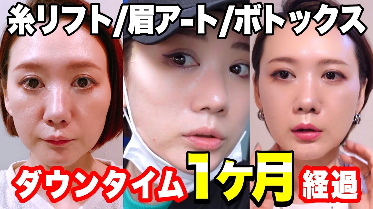 【整形】やる前に見て！韓国で施術した糸リフト眉アートボトックスの1ヶ月後の事実！
