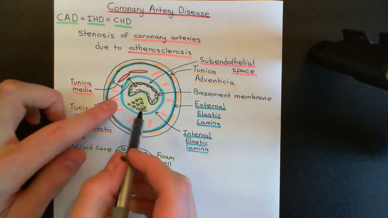 Coronary Artery Disease Part 1