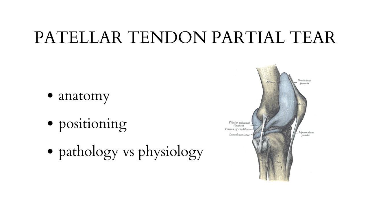 PATELLAR TENDON PARTIAL TEAR - musculoskeletal ultrasound examination