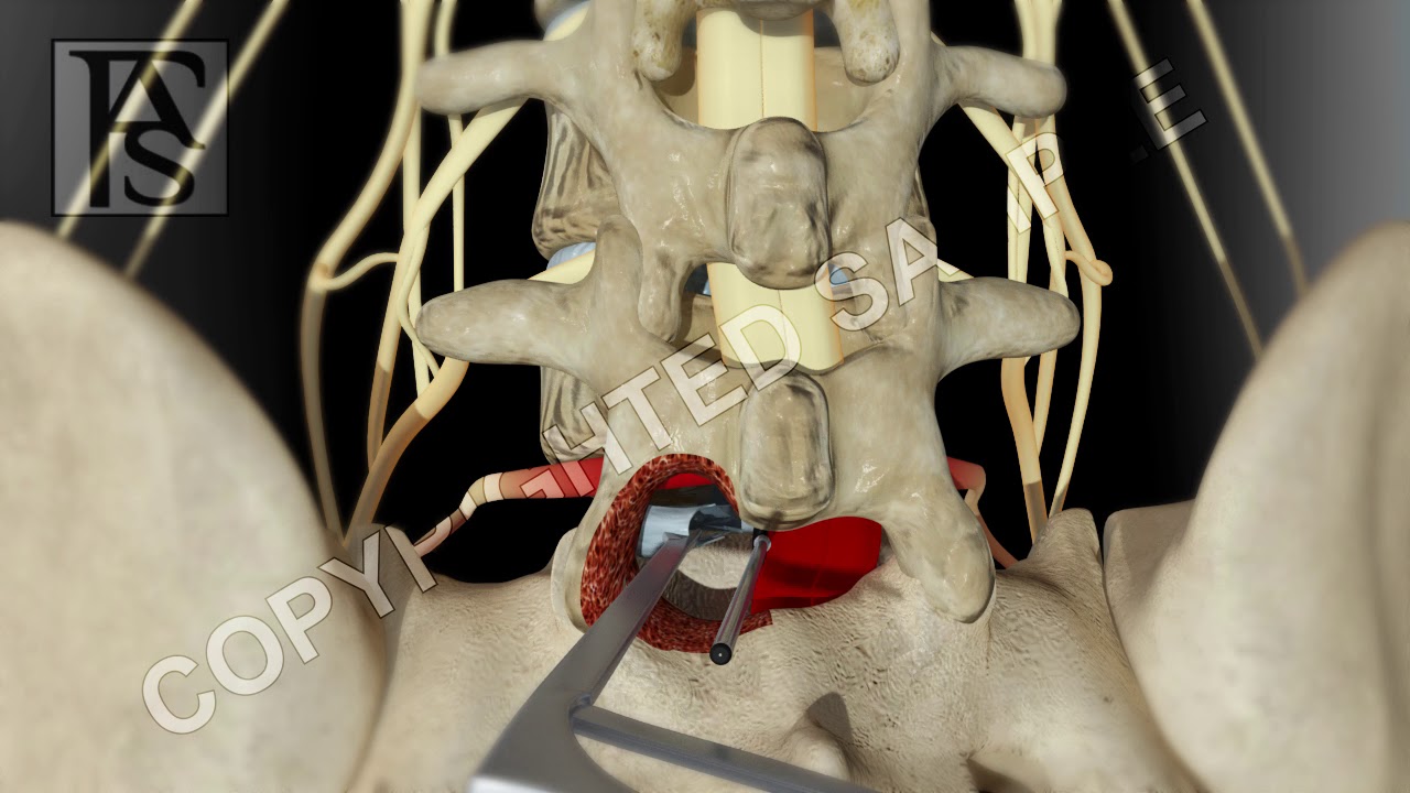 Lumbar Fusion of L5 S1 Hemilaminotomy