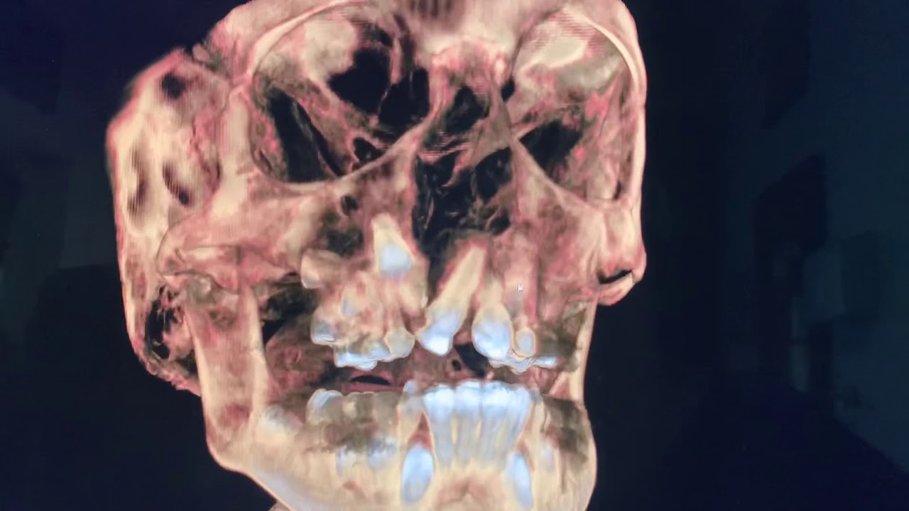 Why a cone beam CT scan analysis is a must before planning maxillary bone grafting for cleft patient