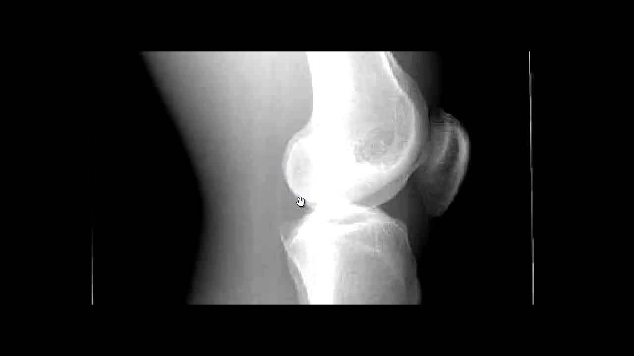 Lateral Knee X-ray and Rotation