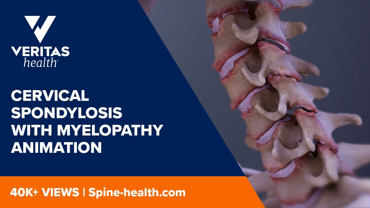 Cervical Spondylosis with Myelopathy Animation