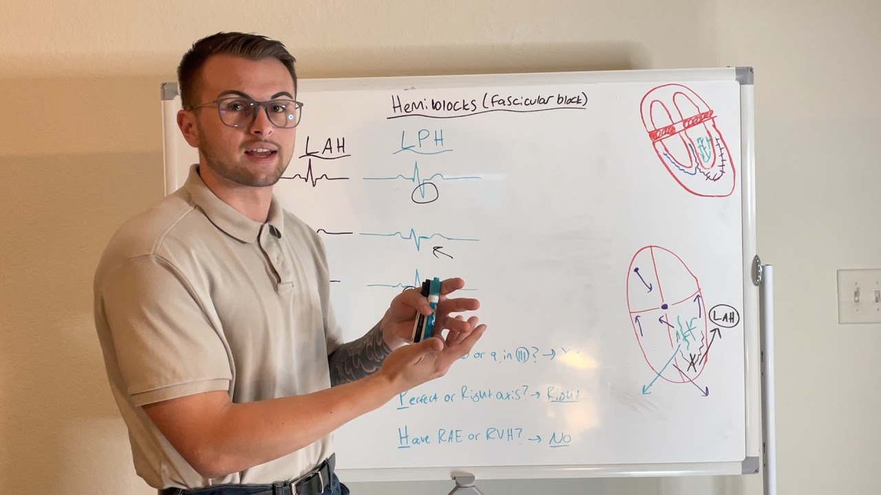EKG Series: Left Anterior and Left Posterior Hemiblocks (Fascicular Blocks)